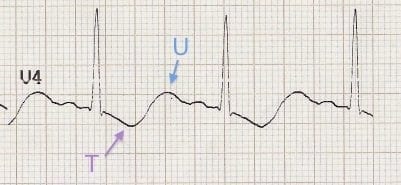 <p>Flat T wave and U wave </p>