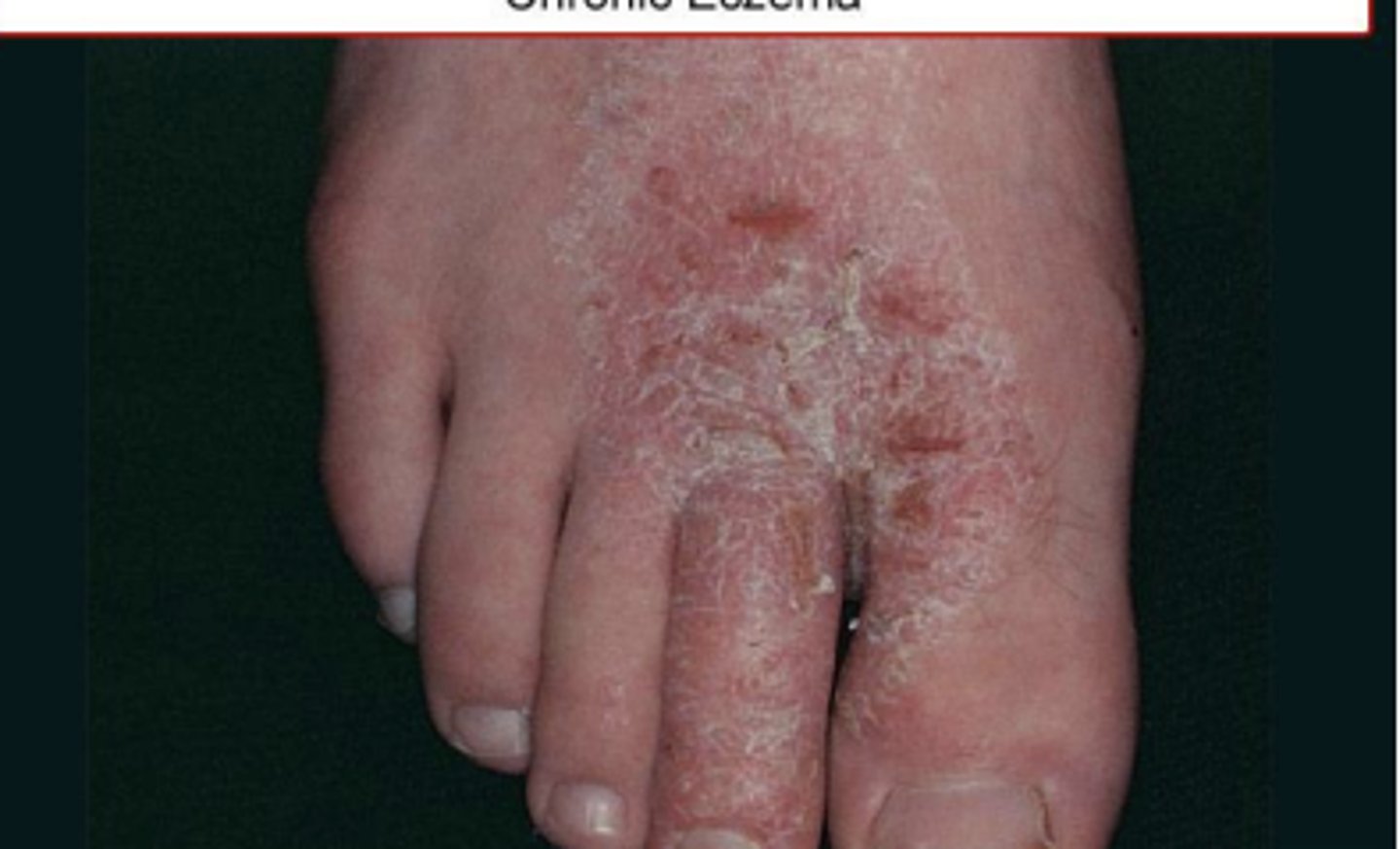 <p>superficial itch inflammation of skin</p>