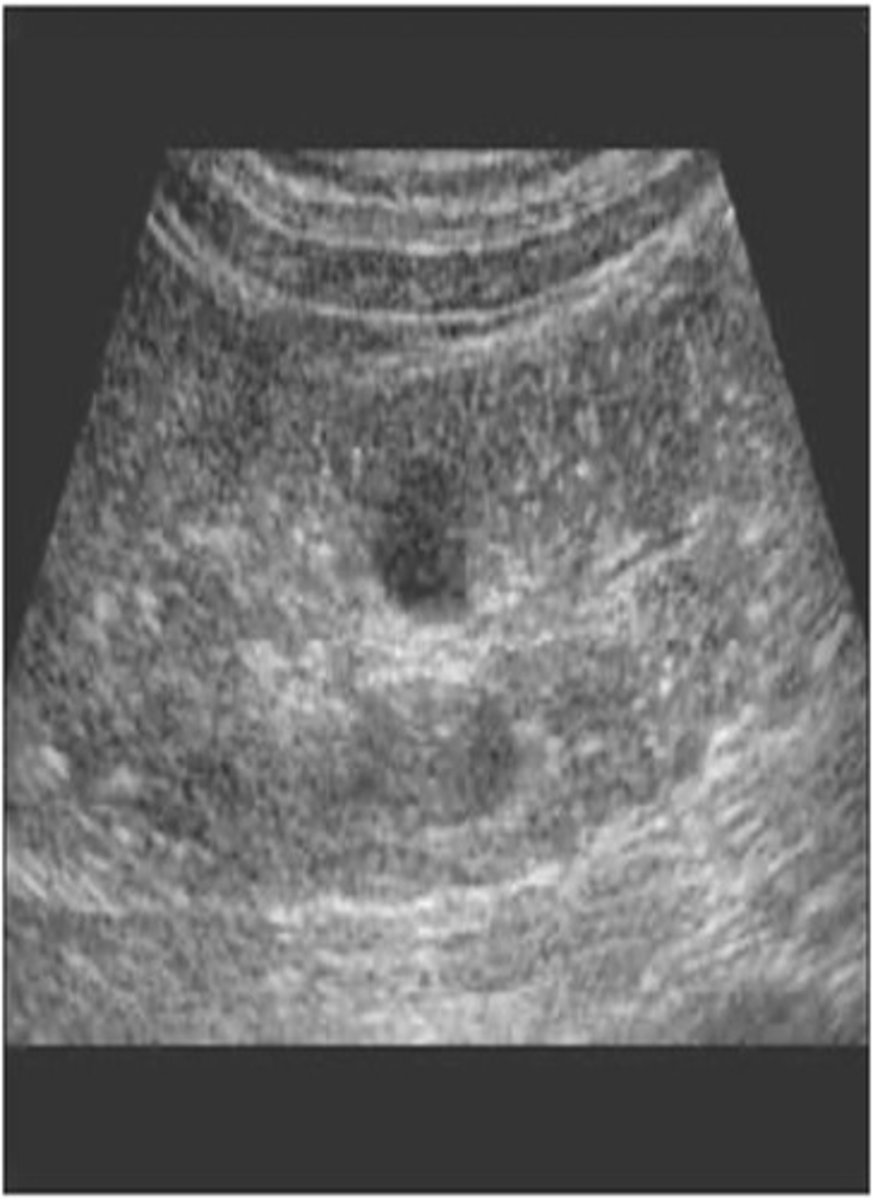 <p>With infantile polycystic kidney disease, ___, ___ kidneys are seen in utero causing renal ___ and fetal ___</p>