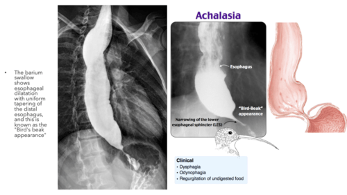 <p>Achalasia</p>