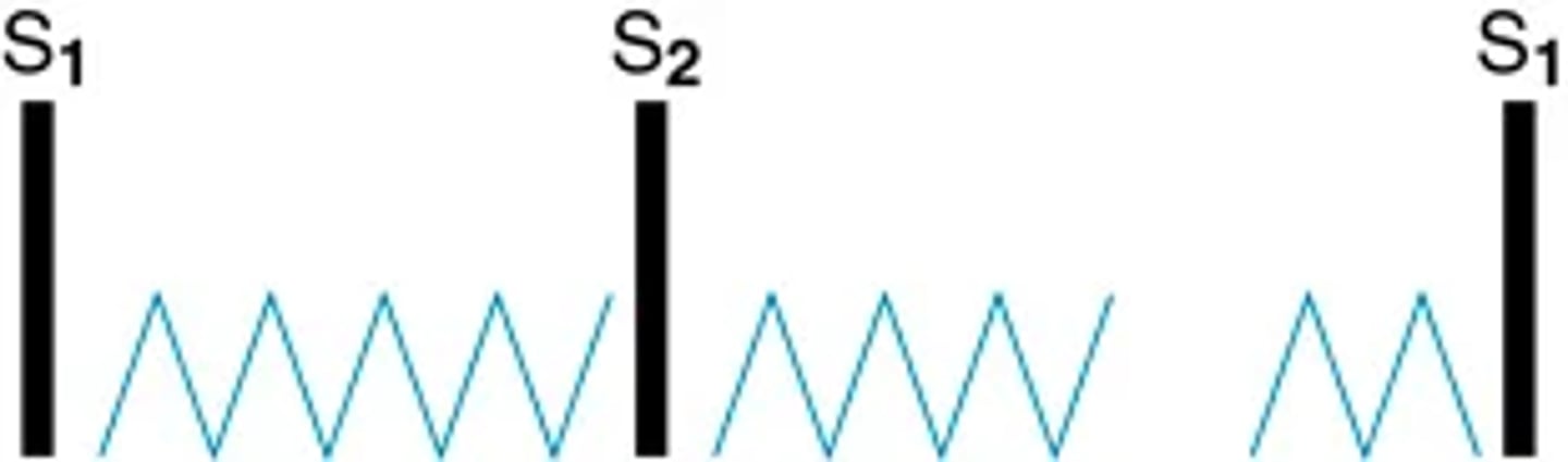 <p>When both the pathologic S3 and S4 are present, a quadruple rhythm is heard.</p><p>(cardiac stress -> tachycardic response)</p><p>During rapid rates the diastolic filling time shortens, and the S3 and S4 move closer together.</p><p>(sound superimposed in mid-diastole, one loud, prolonged, summated sound, often louder than either S1 or S2.)</p><p>IMAGE IS OF EXTRA CARDIAC SOUNDS</p>