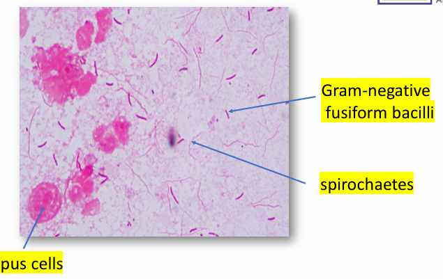 <p>Vincent’s angina</p>