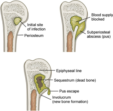 <ul><li><p>Severe infection of bone, bone marrow, and surrounding soft tissue</p></li><li><p>Most common microorganism is Staphylococcus aureus, but can be caused by variety of organisms</p></li></ul><p></p>