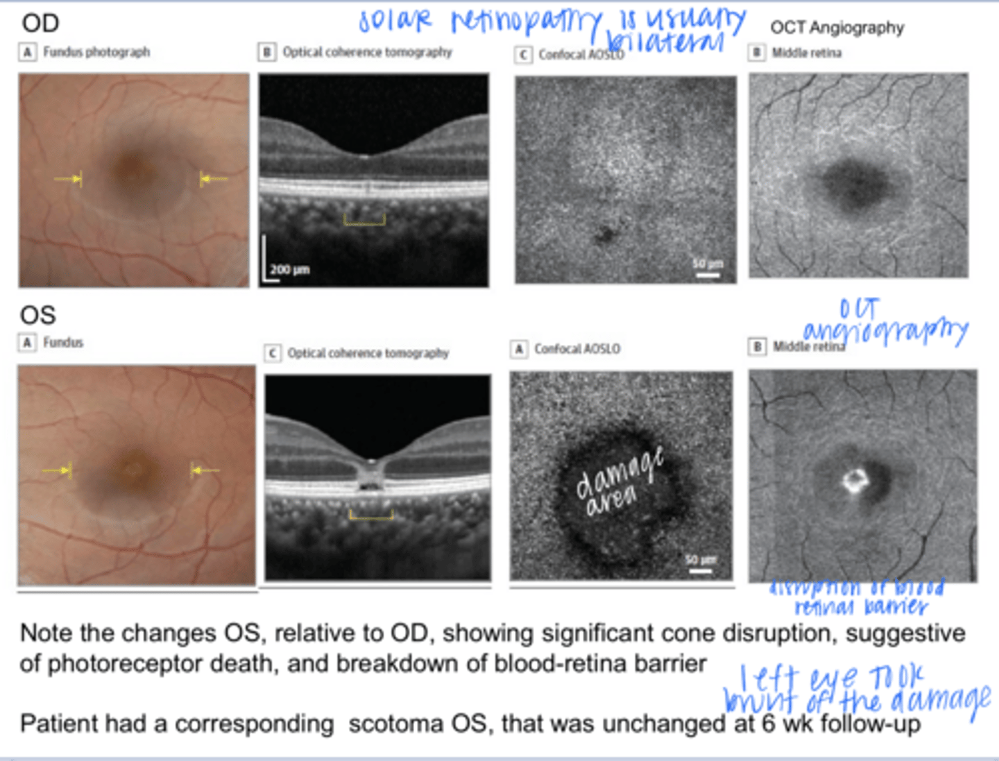 <p>Woman in 20s presents 3 days after Aug 21 2-17 solar eclipse with blurred vision and metamorphopsia OS. Reports she stared at the rim for about 6s with no protection, before looking again with glasses for 20s. VA was 20/20 OD and 20/25 OS.</p><p>OCT images are attached.</p><p>What is being shown in the OS?</p>