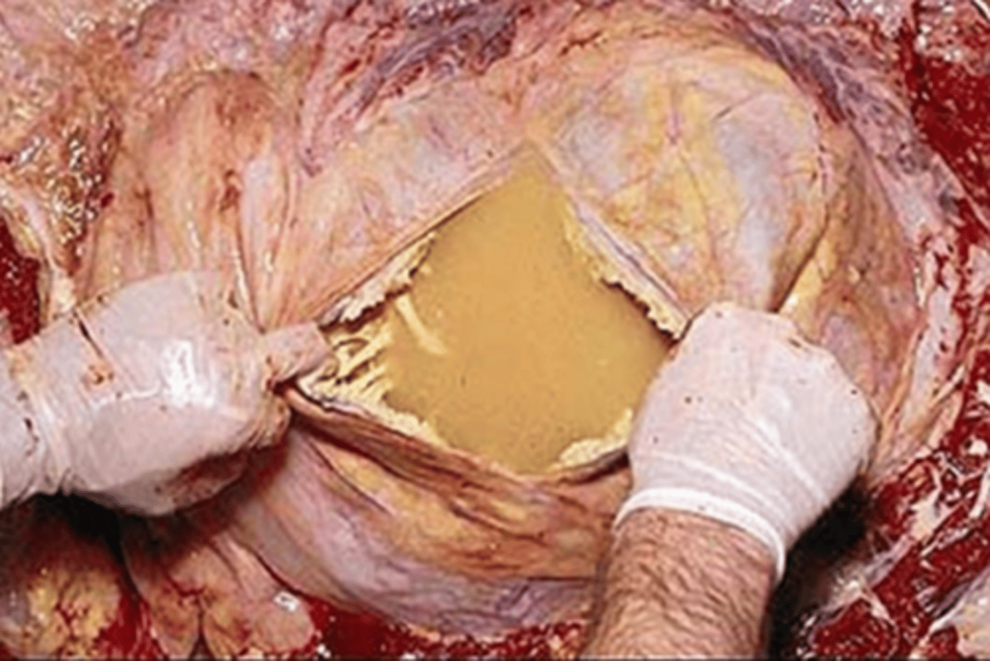 <p>what type of exudate is being depicted in this image?</p>