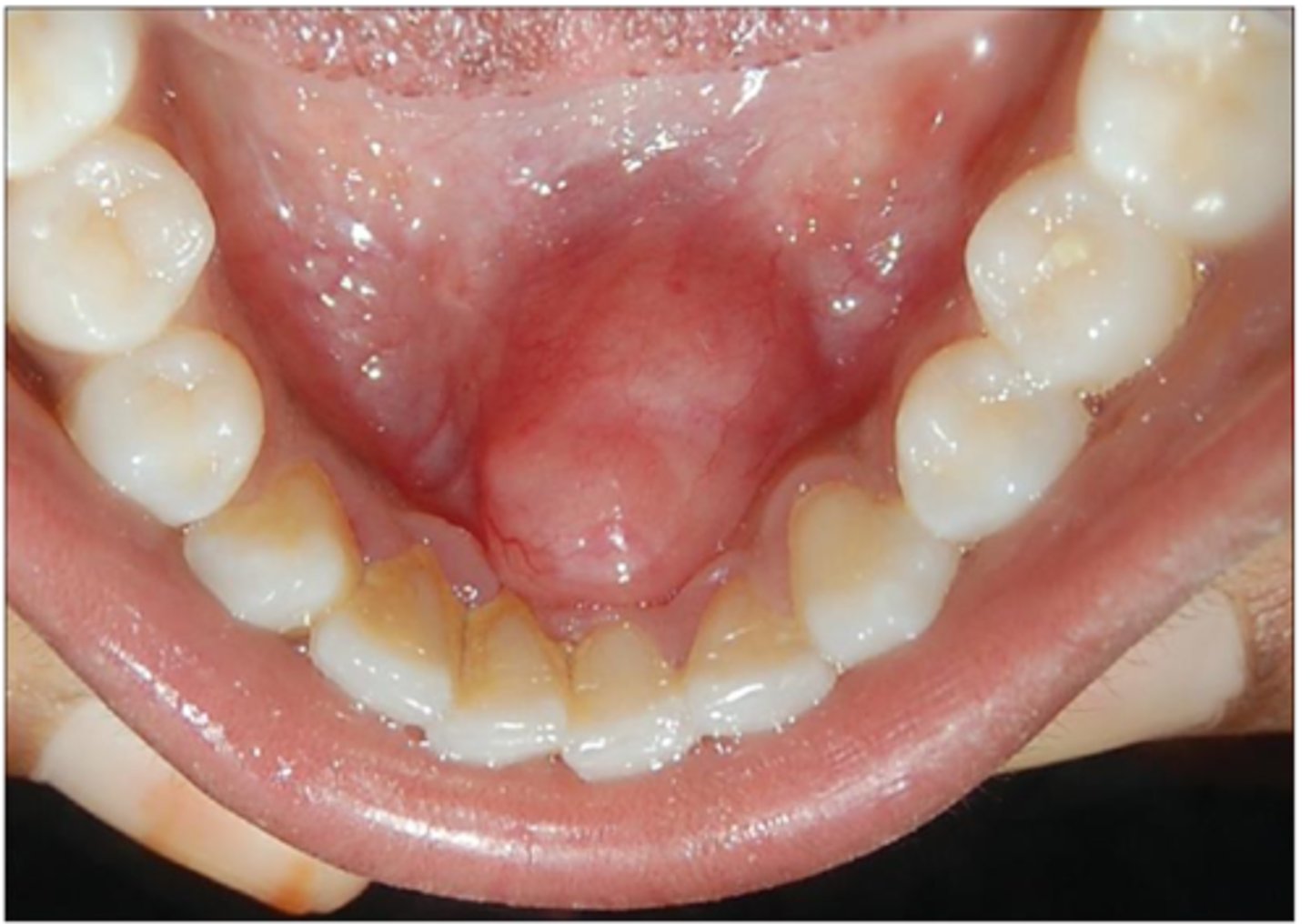 <p>• Slow-growing, encapsulated</p><p>tumor that typically arises in</p><p>association with a nerve trunk</p><p>• Asymptomatic</p><p>• The tongue is the most common</p><p>location for oral _____</p><p>• Can arise centrally</p>