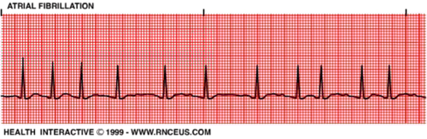 <p>"wavy" lines smaller than saw tooth in atrial flutter</p><p>no pr interval</p><p>still has qrs</p>