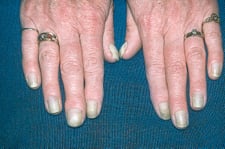 <p>Nails grow slow and are curved</p><p>May be seen in AIDs and respiratory syndromes</p>