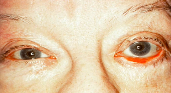 <p>Abnormalities of the External Eye</p><ul><li><p>Outwardly turned lower lid</p></li></ul><p></p>
