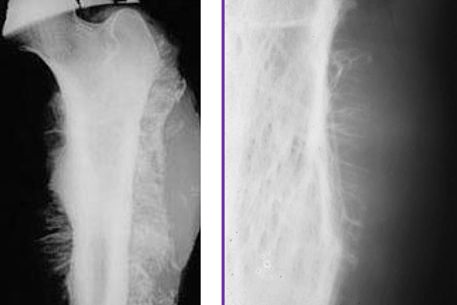 <p>Perpendicular rays of periosteal new bone, seen in osteogenic sarcomas &amp;/or ewings sarcomas</p>