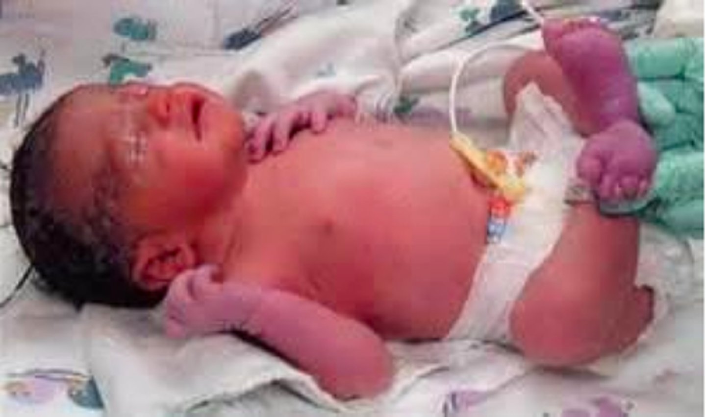 <p>A newborn's skin will initially be deep red to purple with central pink color/BLUENESS of the hands and/or feet and is typical in THE FIRST FEW DAYS AFTER BIRTH. In lighter-skinned infants, the entire foot or hand may appear blue in color. In darker-skinned infants, acrocyanosis may be noted on the soles or palms. This should fade to the color of their genetic background.</p>