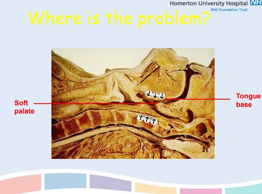 Repetitive episodes of partial or complete upper airway obstruction during sleep