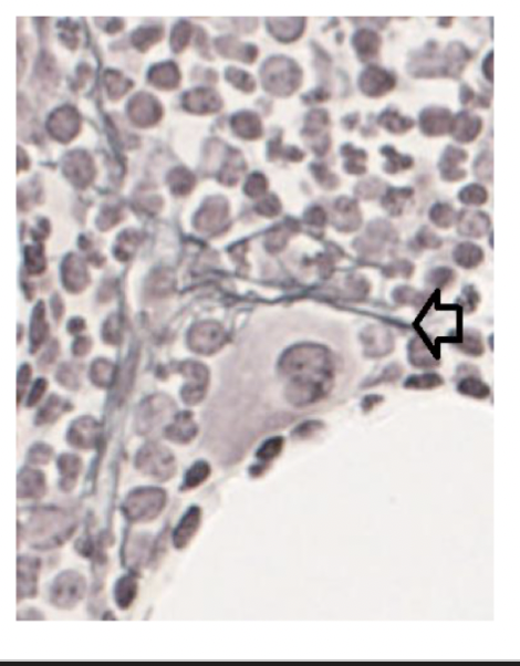 <p>Samma sak som <strong>kollagen typ III</strong>. Huvudsakligen det kollagen som finns i lymfoida vävnad.</p>