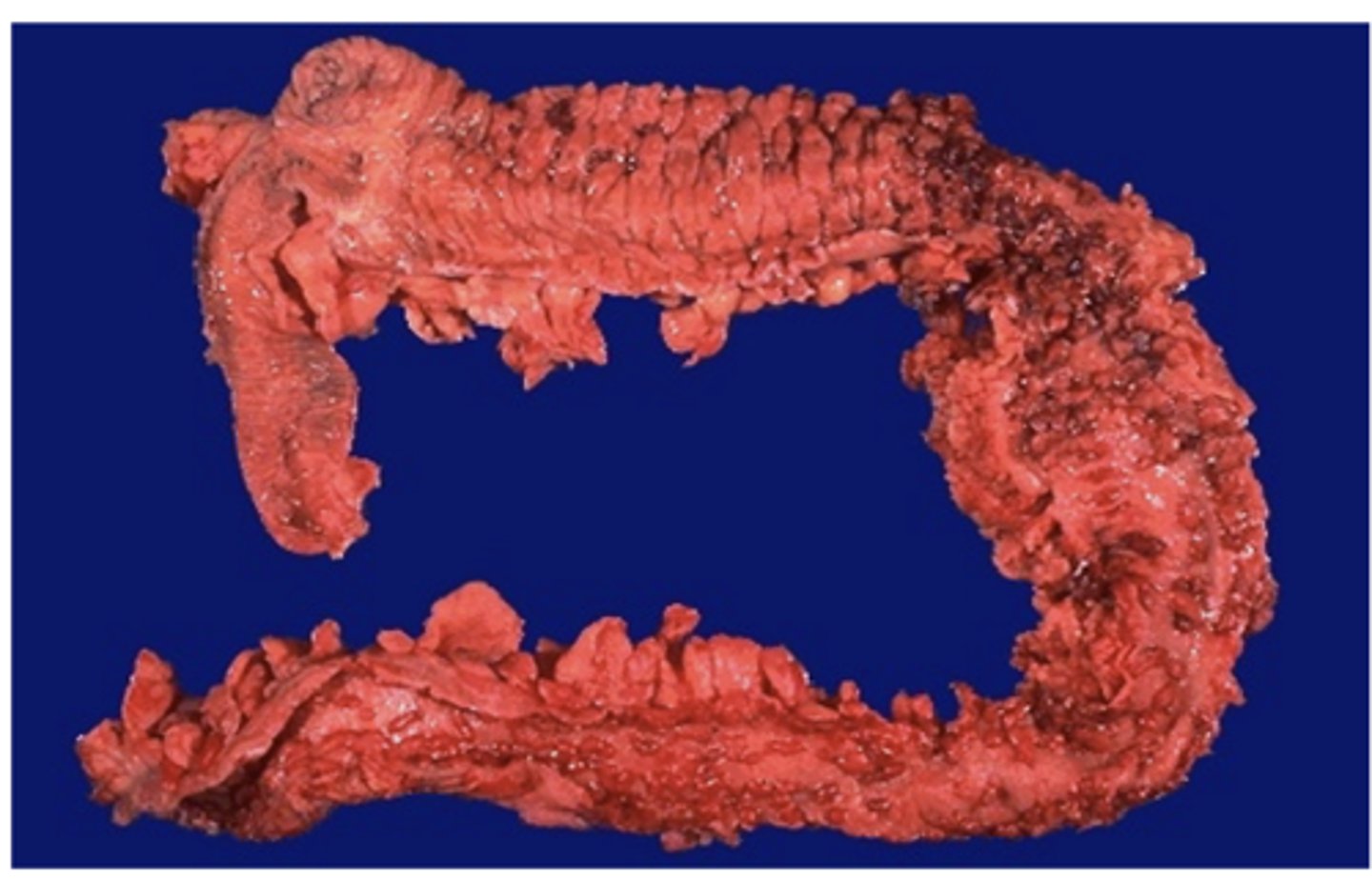 <p>Signs and symptoms of this GI disease include:</p><p>• Fever</p><p>• Abdominal pain</p><p>• Bloody diarrhea, can be nocturnal</p><p>• Extra-intestinal manifestations (skin, joints)</p><p>• Signs of anemia</p><p>• Onset usually 15-25, can be later (same as CD)</p>