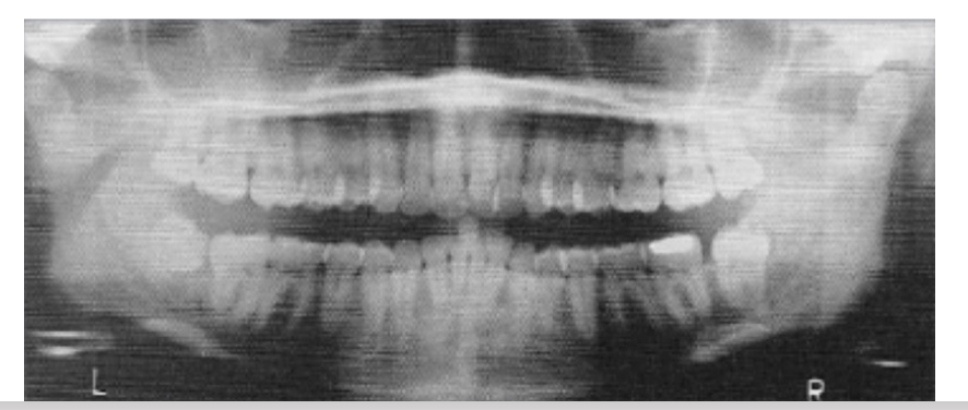 <p>Occlusal plane will be flat or inverted, resulting in distortion of mandible, and a radiopaque shadow of the hard palate on the apices of maxillary teeth.</p>