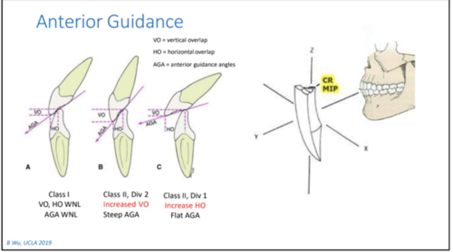 <p>Anterior guidance (vertical and horizontal overlap of anterior teeth)</p>