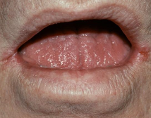 <p>What is angular cheilitis? </p>