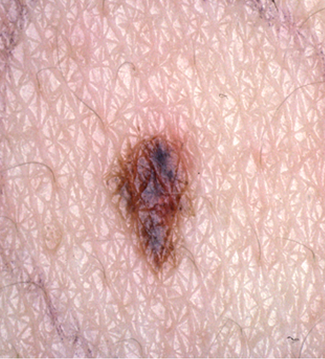 <ul><li><p>precursor of malignant melanoma</p></li><li><p>diameter > 5mm</p></li><li><p>fried egg appearance- macular component w/ papular center</p></li><li><p>asymmetry</p></li><li><p>notched, irregular, ill-defined borders </p></li><li><p>variegated color w/ areas of pink, tan, brown, dark brown</p></li></ul><p></p>