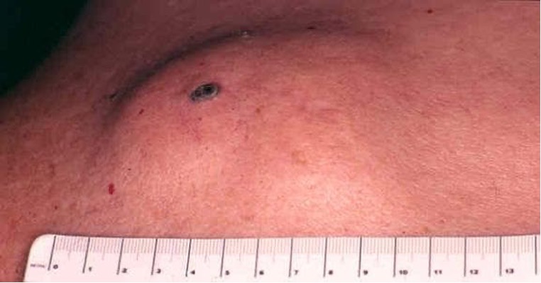 <p>what is the most common type of cutaneous cyst that may result from trauma of follicular epithelium or comedones?</p>