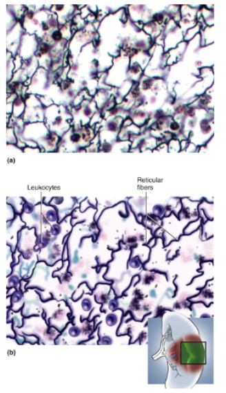 <p>Loose network of reticular fibers and cells, infiltrated with numerous leukocytes, especially lymphocytes</p>