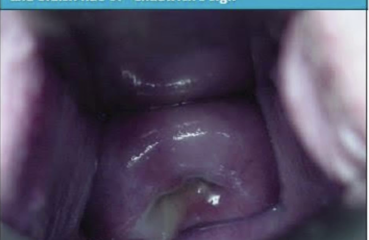 <p>What happens to the cervix in pregnancy?</p>