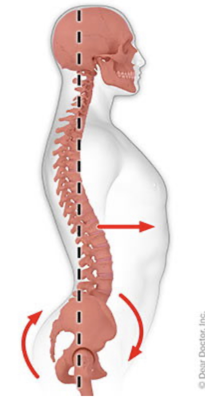 <p>hyperlordosis</p>