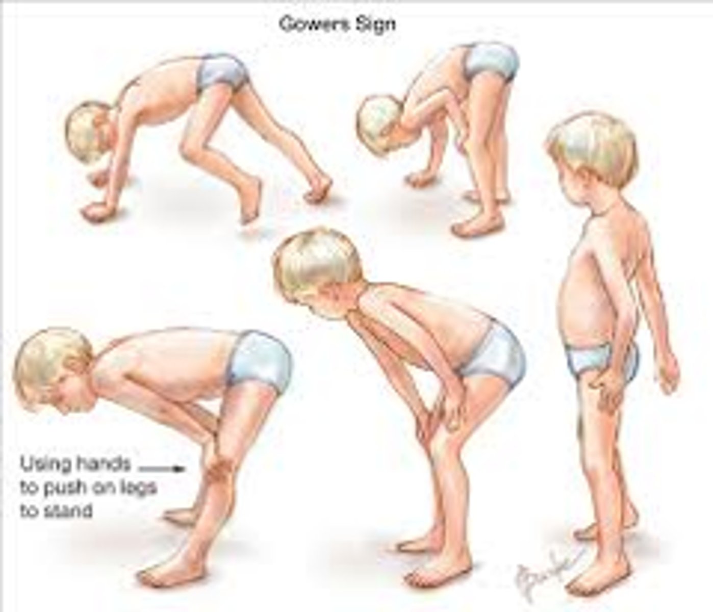 <p>a physical examination finding where a person uses their hands to "walk" up their own body to stand from a prone or squatting position</p>