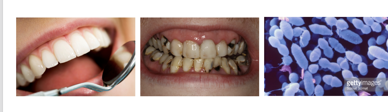 <p><strong>S. Mutans</strong> ( BAD) - a<strong> prominent cause of tooth decay </strong>( produces lactic acid that dissolves teeth enamel and inhibits growth of other bacteria) </p><p><strong>S. Sanguines </strong>( GOOD ) -<strong> beneficial bacterium</strong> that competes with S. Mutans by producing hydrogen peroxide </p>