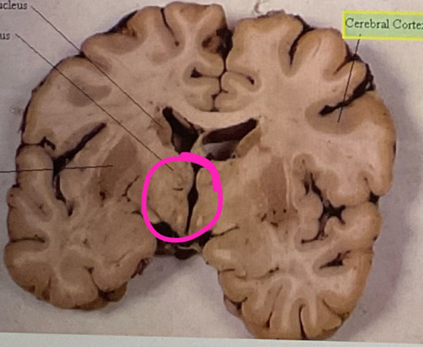 <p>Third Ventricle</p>
