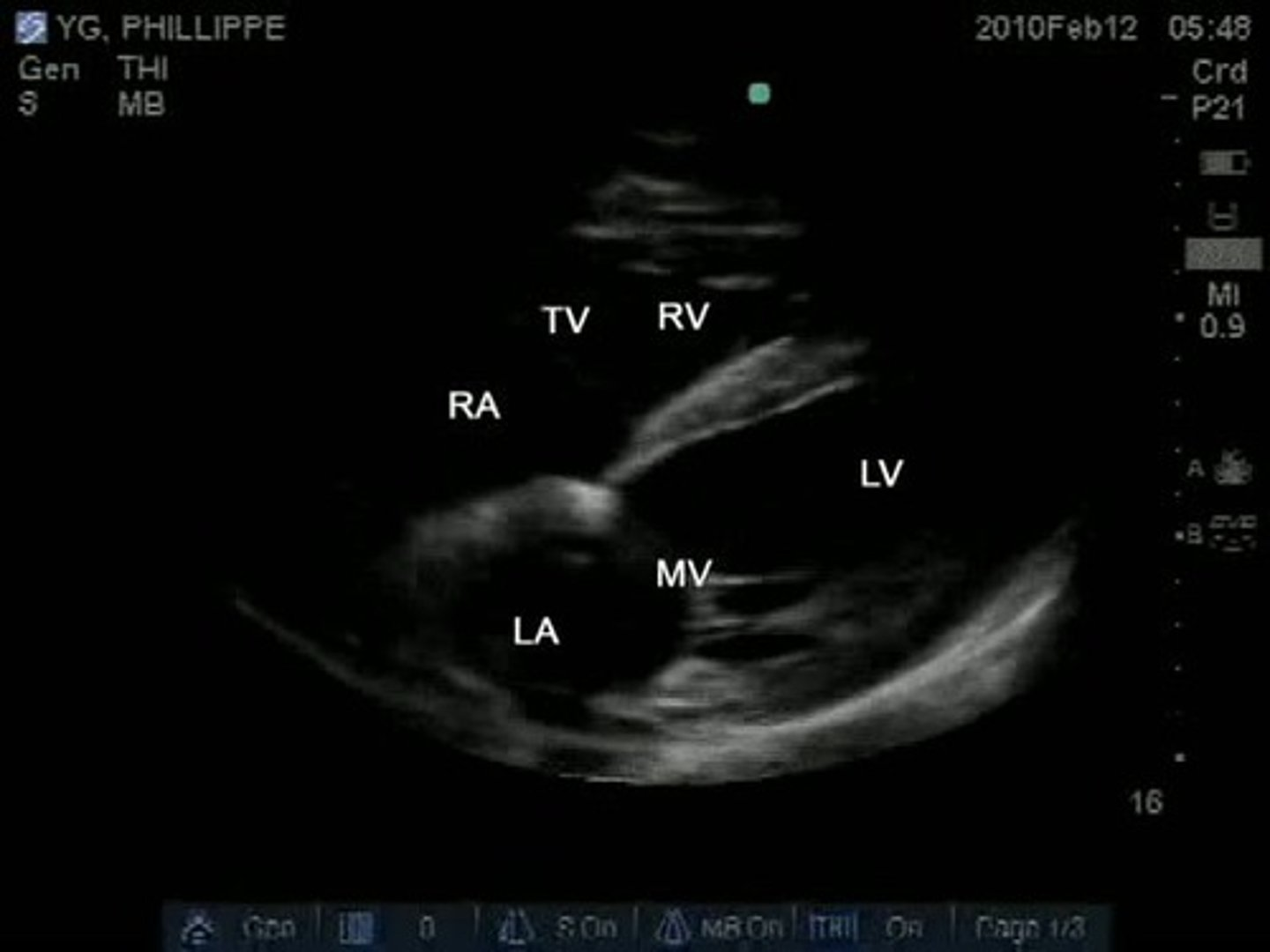 <p>subcostal 4 is used to visualize _______, ___, ___, ____, and ___</p>