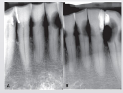 <p>seen on surfaces and teeth that do not usually present carious- often cervical location </p>