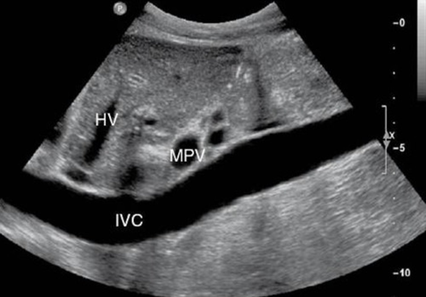<p>15-25 mm</p><p>valsalva = max diameter</p>