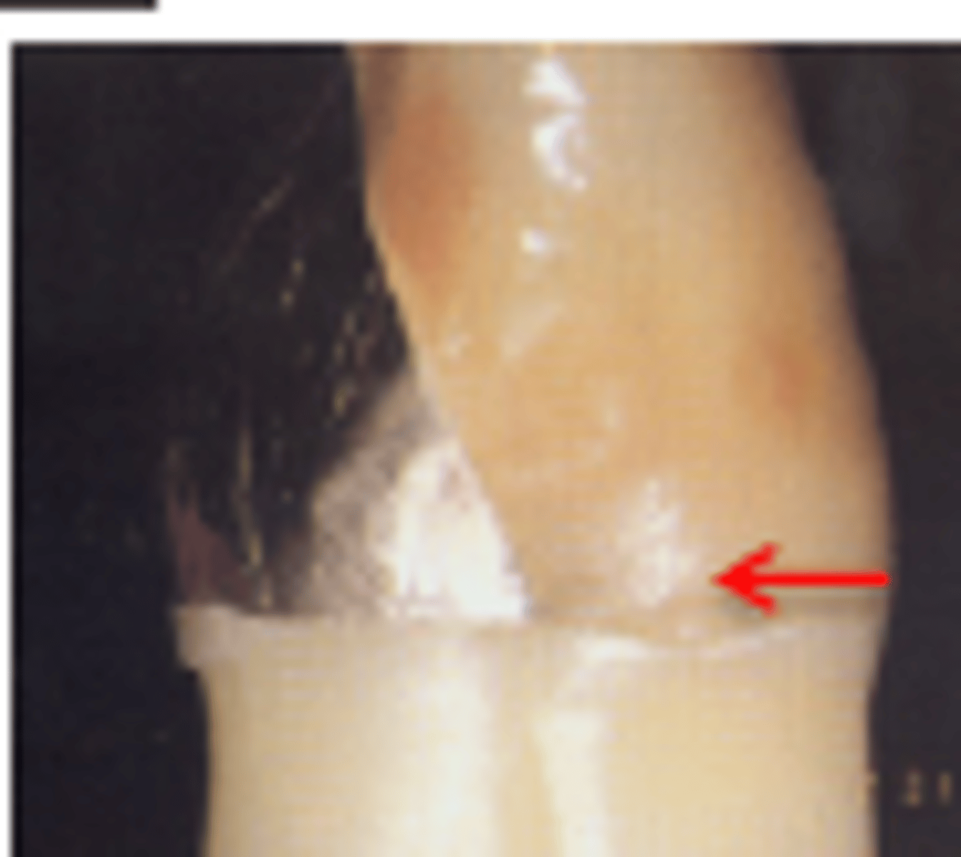 <p>Porcelain butt joint or collarless design</p>
