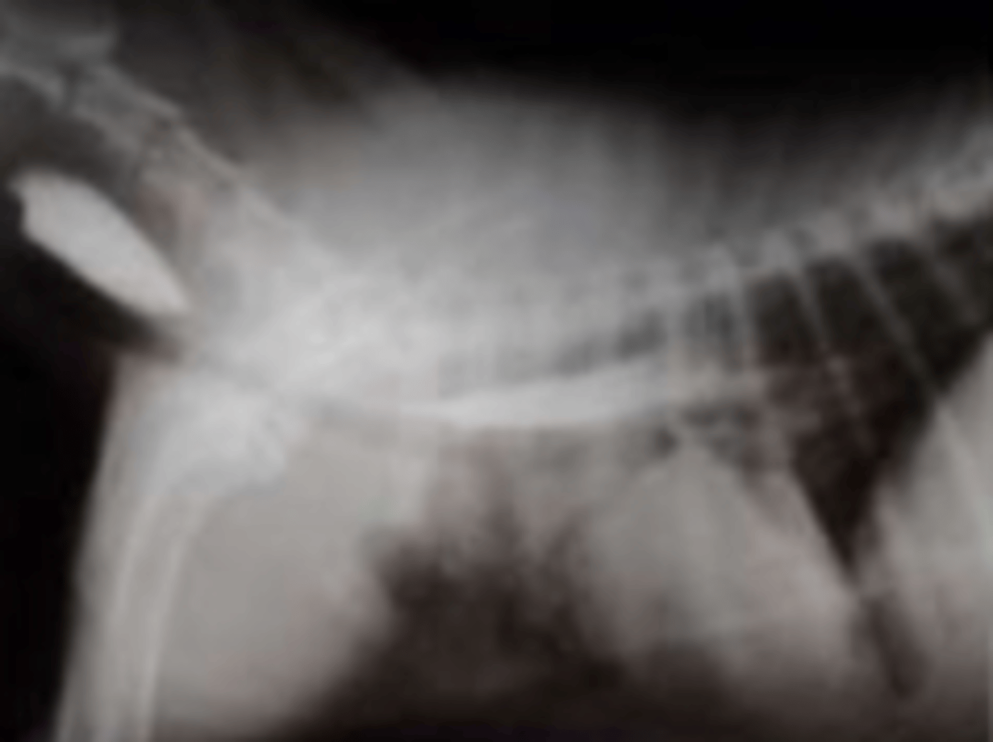 <p>what is the cause of this esophageal stenosis?</p>