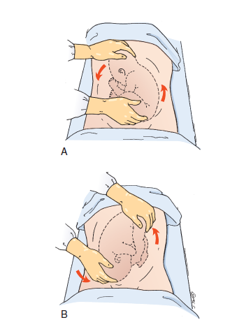 <p>Used in an attempt to turn the fetus<span style="color: yellow"><strong> from a breech or shoulder presentation to a vertex presentation</strong></span> for birth. It may be attempted in a labour and birth</p><p>setting at<span style="color: yellow"><strong> 36 to 37 weeks </strong></span>of gestation. </p><p>ECV is accomplished by the exertion of gentle, constant pressure on the abdomen. At this gestational age, the success rate for ECV is approximately 65% and the <span style="color: yellow"><strong>risk for Caesarean birth is reduced by 50%</strong></span></p><p></p><p><span style="color: #ffffff">During procedure monitor for:</span></p><p><span style="color: yellow">Fetal heart rate and pattern<strong>,</strong></span><span style="color: #fefefe"> especially for </span><span style="color: yellow"><strong>bradycardia and variable decelerations</strong></span></p>