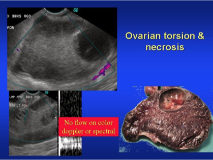 <p>Ovarian Torsion”medical emergency</p><p><span>•Enlarged edematous ovary &gt;4cm</span></p><p><span>•Hyperechoic, heterogenous mass</span></p><p><span>•Free fluid</span></p><p><span>•Blood Flow</span></p><p><span>•May be completely absent</span></p><p><span>•Dilated vessels on periphery</span></p><p><span>•Venous thrombosis before arterial thrombosis</span></p>