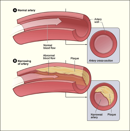 <ul><li><p><em>The build-up </em><strong><em>forms an atheroma</em></strong><em> (degeneration of the walls of the arteries) </em><strong><em>under the endothelium</em></strong><em> (cells that line the interior surface of blood vessels).</em></p></li><li><p>As the atheroma grows the artery thickens and l<strong>oses its elasticity</strong>.</p></li><li><p>The diameter of the lumen becomes <strong>reduced</strong>.</p></li></ul><p></p>
