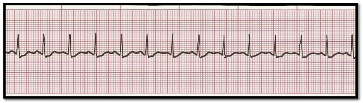 <p>What is the rhythm?</p>