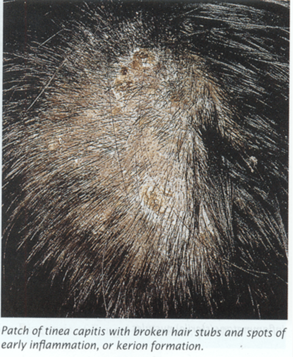 <p>name this skin pathology</p>