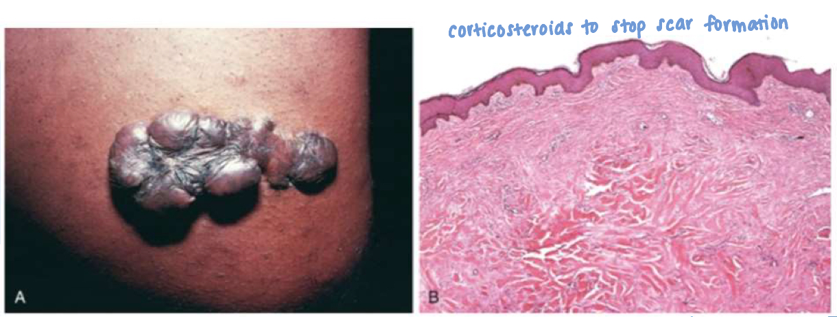 <p>prominent raised scars resulting from excess production of ECM</p>