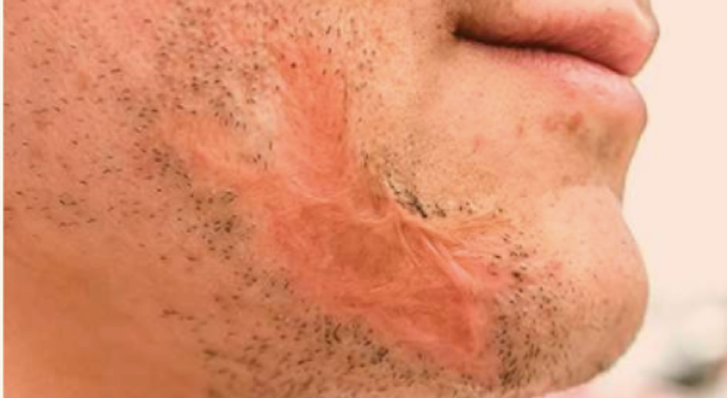 <p>¿lesión?</p><p>¿primaria o secundaria?</p>