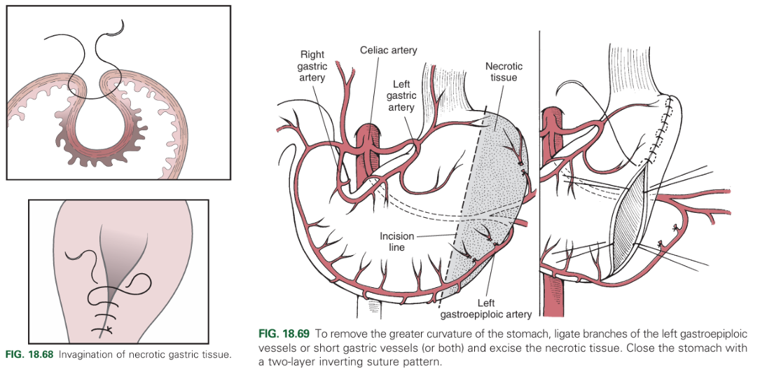 <p>Partial resection of a portion of the stomach. Can be done by invagination or resection.</p>