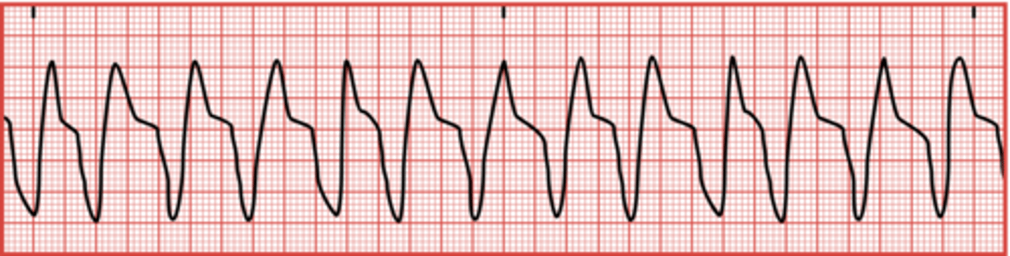 <p>A condition where the ventricles beat at extremely rapid rates, ranging from 101 to 250 beats/min.</p>