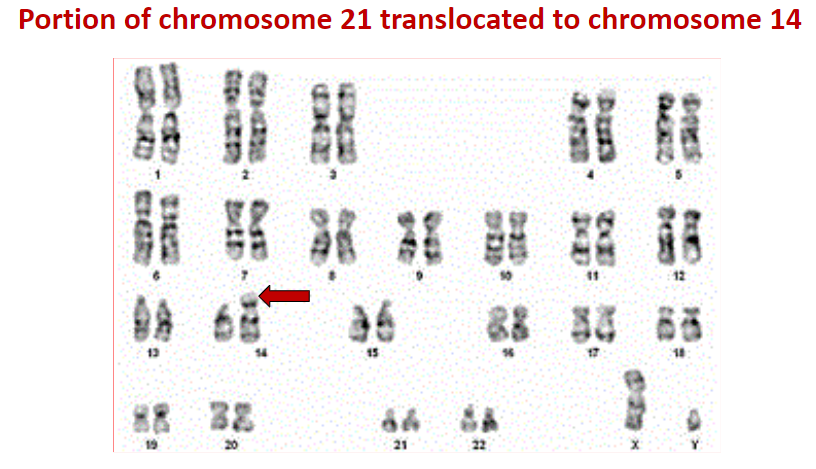 <p>portion of chromosome 21 translocated to chromosome 14</p>