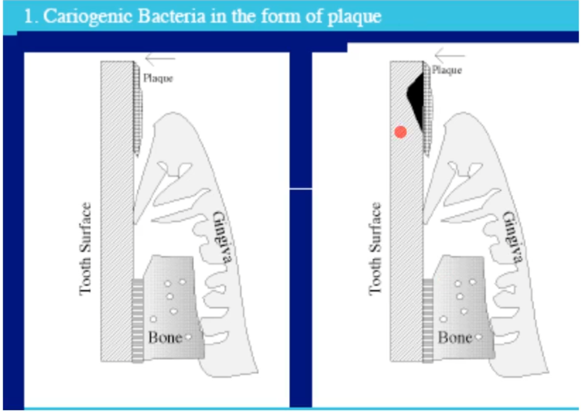 <p>True, Streptococcus mutans is a notorious acid producer that is a early colonizer and when the conditions are met for acids to be produces, the acids will begin to eat away at the enamel (demineralization of the enamel)</p>