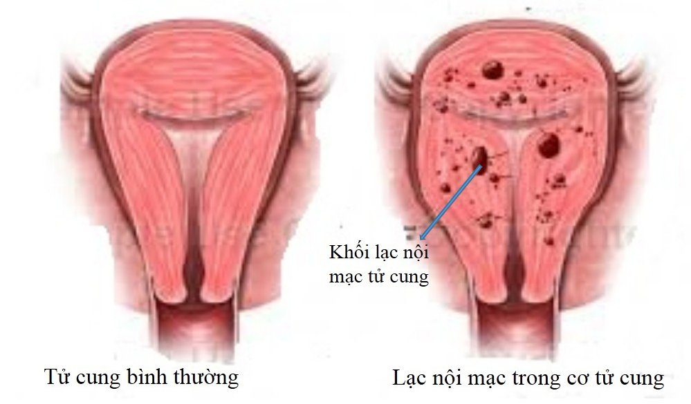 <p>lạc nội mạc tử cung</p>