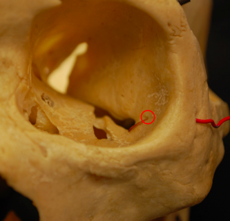 opening in the zygomatic bone that carries the zygomatic nerve and blood vessels
**some people have 1, some have 2 (each one opens up into either the zygomaticofacial or zygomaticotemporal)