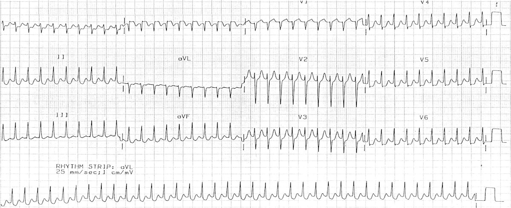 <p>anterograde conduction (towards vents) occurs through normal pathway and up accessory pathway</p><p>produces regular narrow complex tachycardia</p>