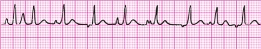 <p>Average HR >100, irregular, at least 3 different P wave shapes, variable PR interval with narrow <0.12 sec QRS</p>