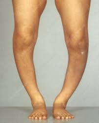 bones become softer because of a vitamin D deficiency (can't become mineralized)